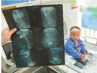  湖南省儿童医院，胡雨晨小朋友长了三个肾，但他仍显得十分活泼。 记者 龚磊 摄