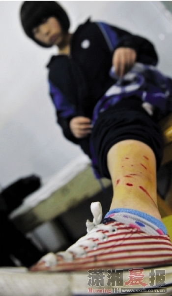  昨日，长沙市疾控中心，被狗咬伤的学生做伤口处理。图/记者张轶