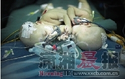  昨日上午，湖南省儿童医院手术室，联体女婴千言万语在做术前准备。图/记者杨抒怀