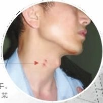 ▲事情过去几天，邓铁荣脖子上的伤痕仍然清晰可见。通讯员摄
