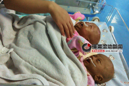 (8月9日，在湖南省儿童医院重症监护室，羸弱瘦小的早产儿大毛和二毛。图/潇湘晨报滚动新闻记者 刘少龙)