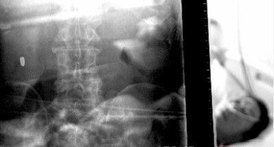 10月10日，长沙市第八医院，62岁的魏桂兴手术后躺在病床上，X光片显示当时子弹位于左腰。