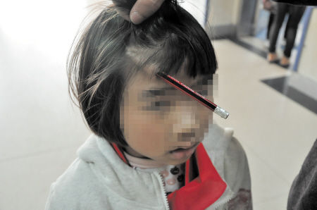 铅笔不慎插入女童头部，令人揪心。陈颖 摄