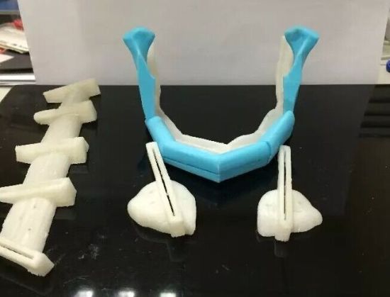 下颌骨恶性肿瘤不惧毁容 3D数字雕塑还患者完